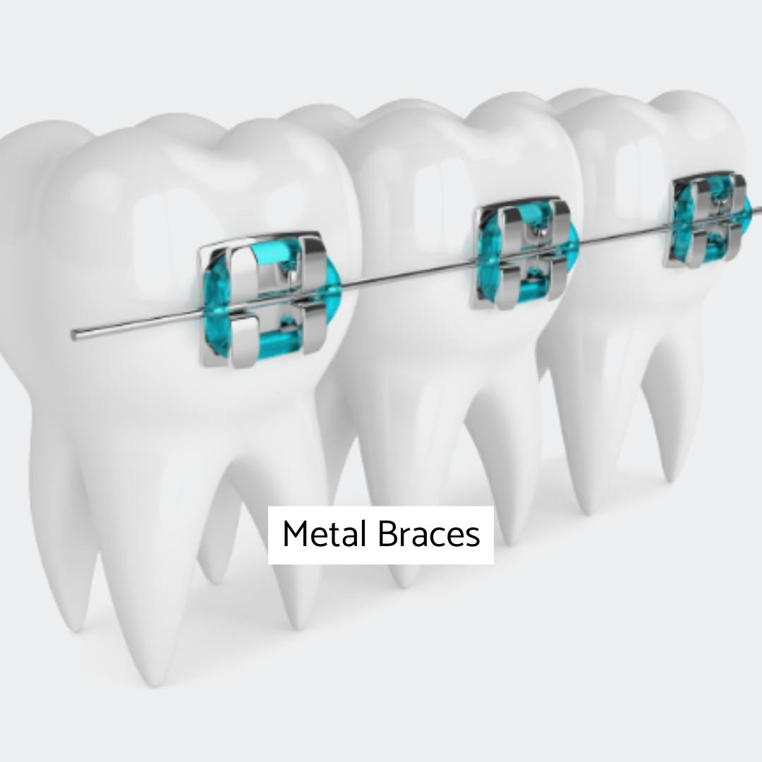 Metal Braces London