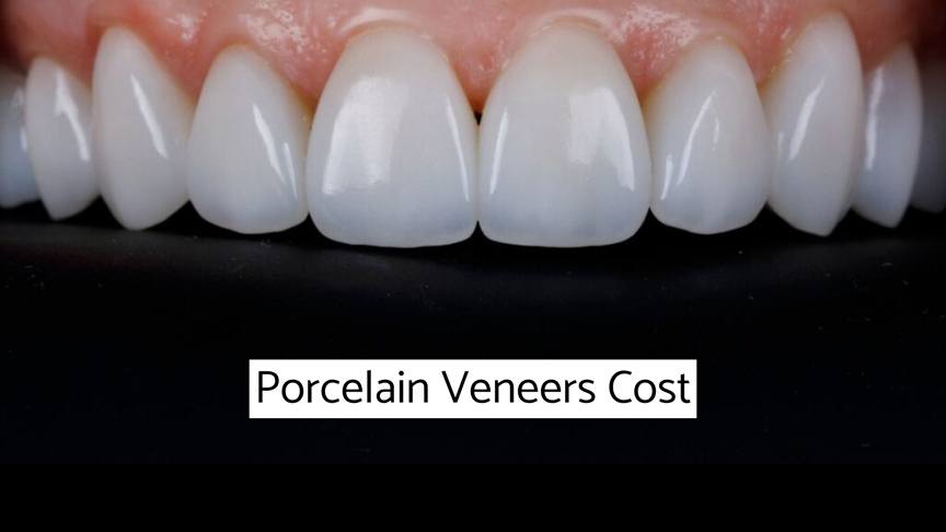 Porcelain Veneers Cost - how much are porcelain veneers