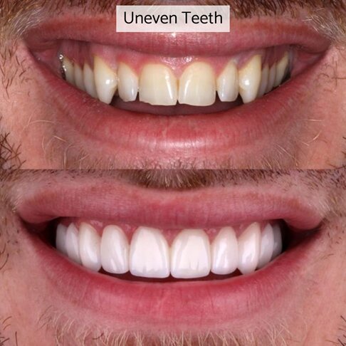 Porcelain veneers can fix unevenly shaped teeth