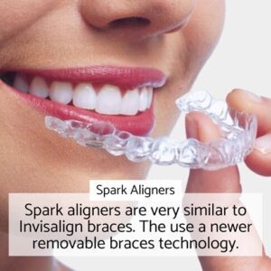Removable braces London - Spark