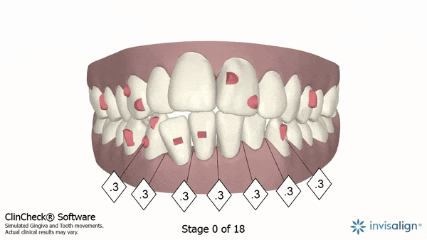 Invisalign clincheck smile simulation for teeth alignment in London