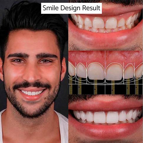 Man patient digital smile design for porcelain veneers