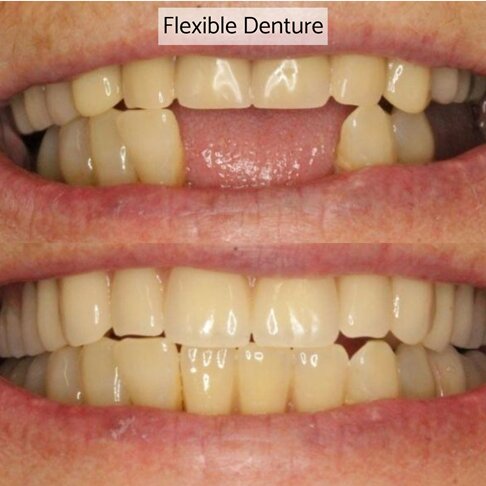 Partial acrylic denture before and after
