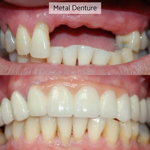 Partial chrome metal denture before and after