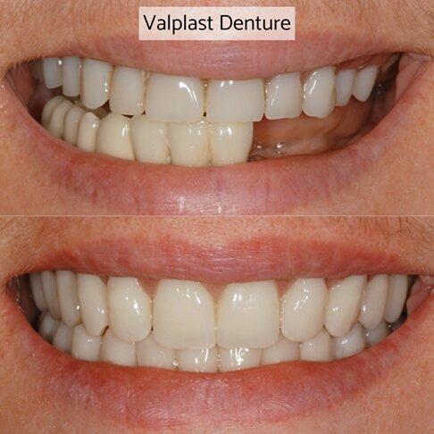 Partial flexible valplast denture before and after