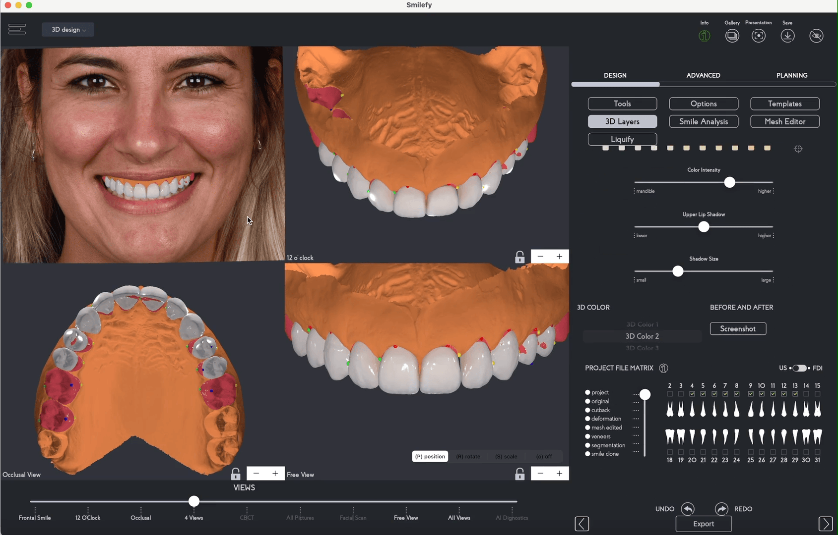 Trial smile design process for porcelain veneers
