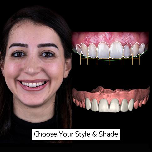 Woman patient digital smile design for porcelain veneers