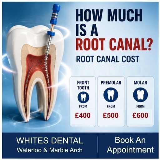 How Much Is A Root Canal In London