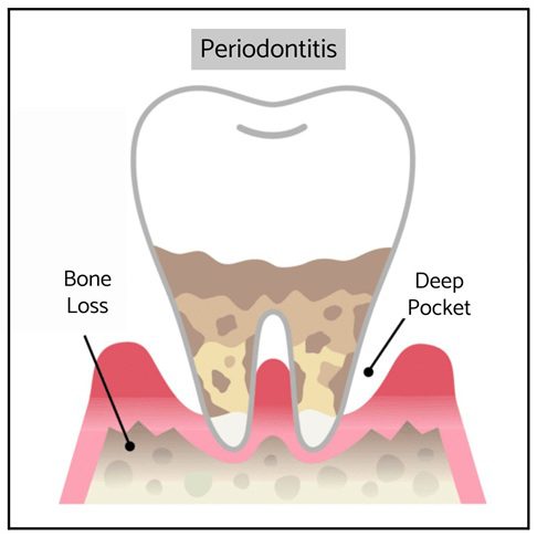 Periodontitis treatment in London
