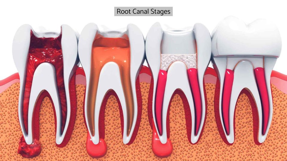 Root Canal Stages And Costs