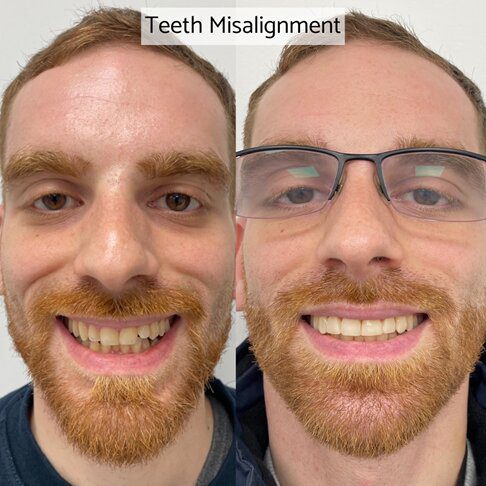 Emax veneers London - misaligned teeth fixed - before and after picture