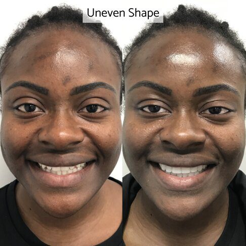 Emax veneers London - unevenly shaped teeth before and after picture