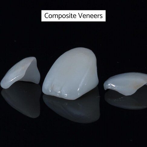 Veneers Cost London - Composite Veneer