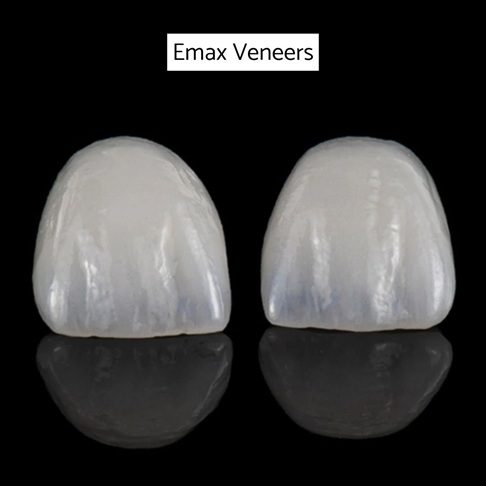 Veneers Cost London - Emax Veneer