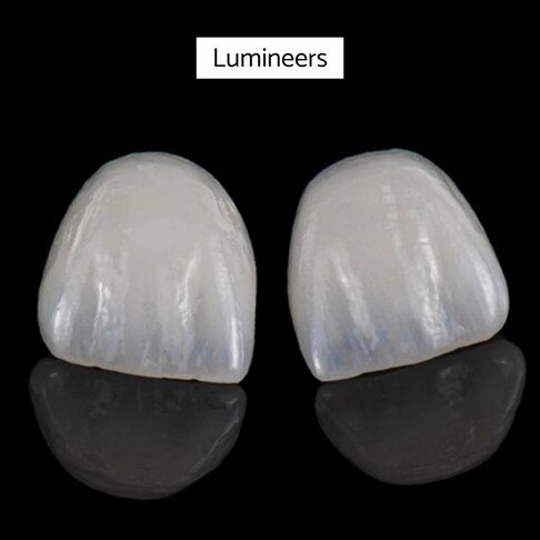 Veneers Cost London - Lumineer Veneer
