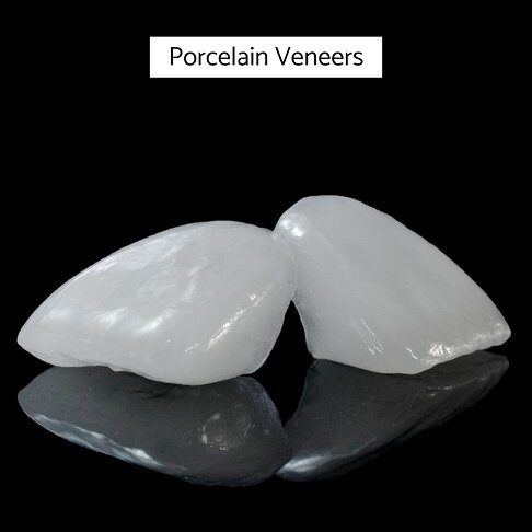 Veneers Cost London - Porcelain Veneer