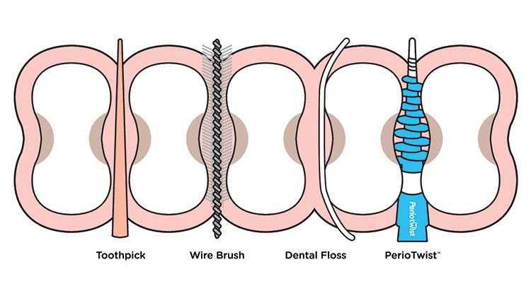 Flossing For Periodontal Disease