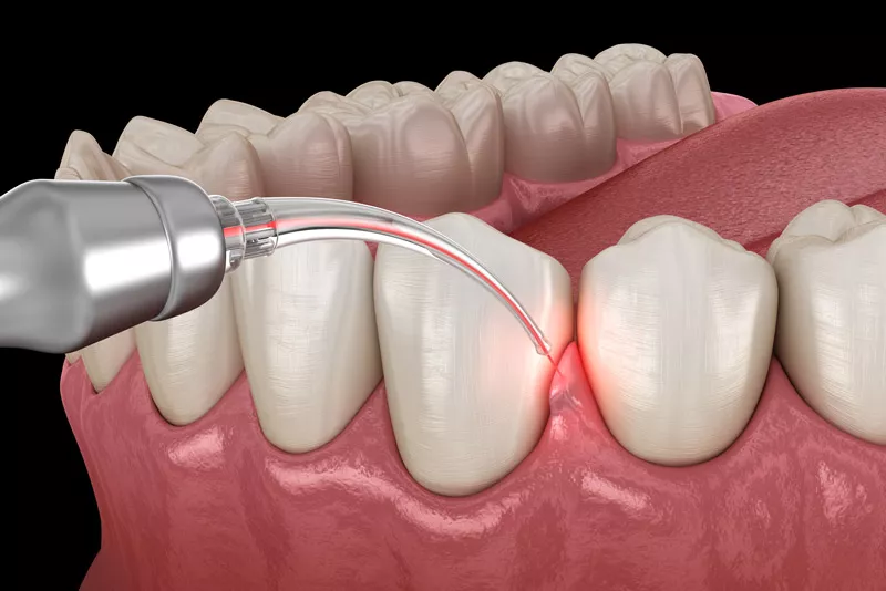 Laser Periodontal Therapy