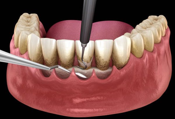 Scaling and root planing