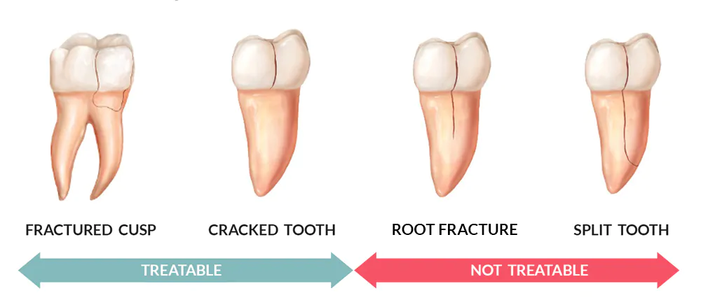 Types Of Cracked Teeth - Treatable Or not