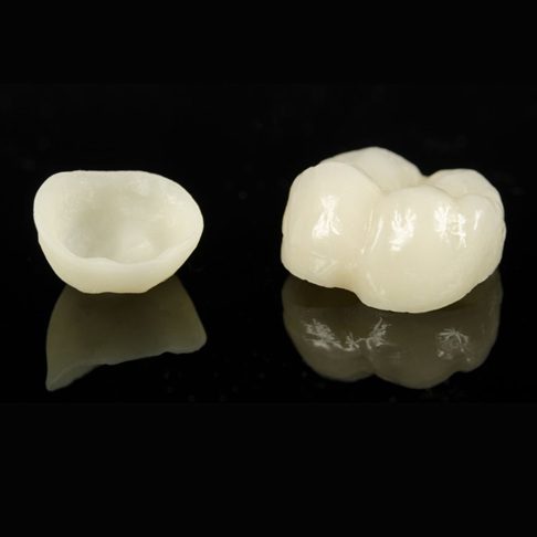 Ceramic crown - Whites Dental London