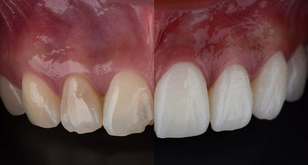 Composite veneers - what are they