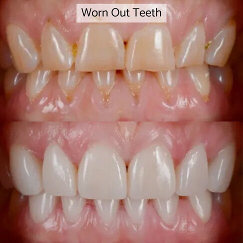 Emax Veneers can correct worn out teeth