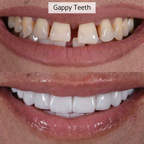 Emax veneers can correct gappy teeth