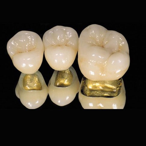 Gold crown - Whites Dental London