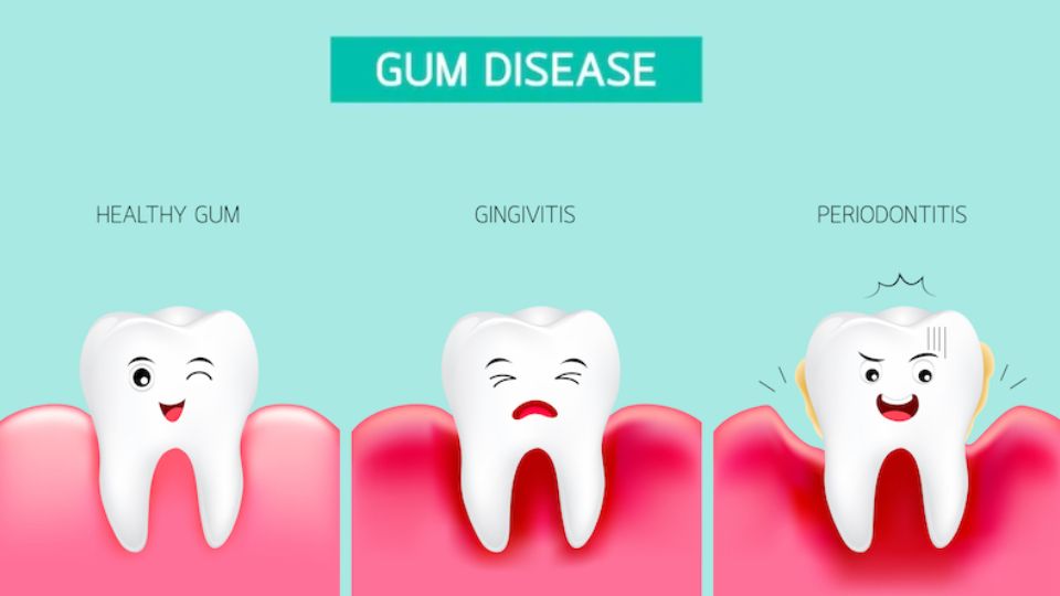 Periodontal Disease - Tooth Loss