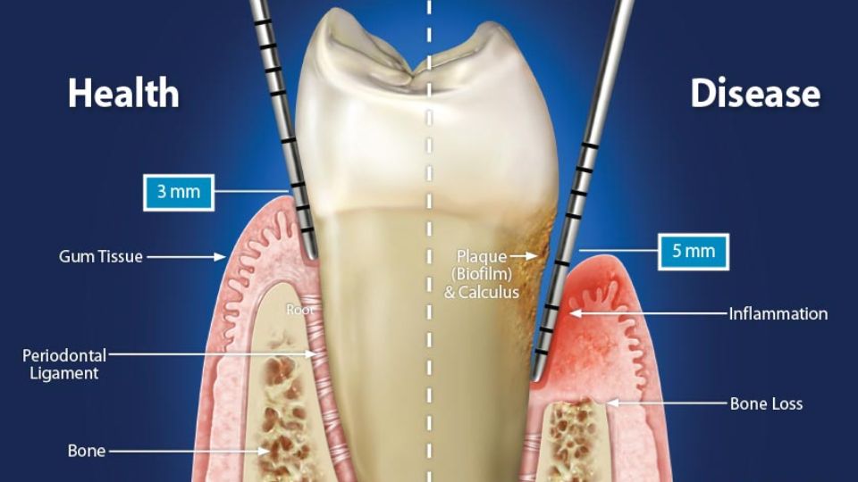 Periodontal pocket
