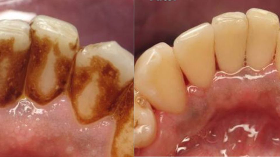 Periodontal treatment success rate