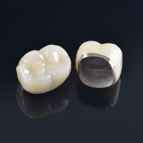 Porcelain Bonded crown - Whites Dental London
