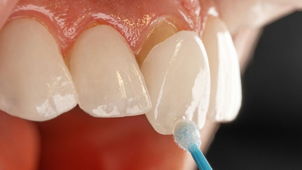 Porcelain veneer being applied to a tooth - Whites Dental London