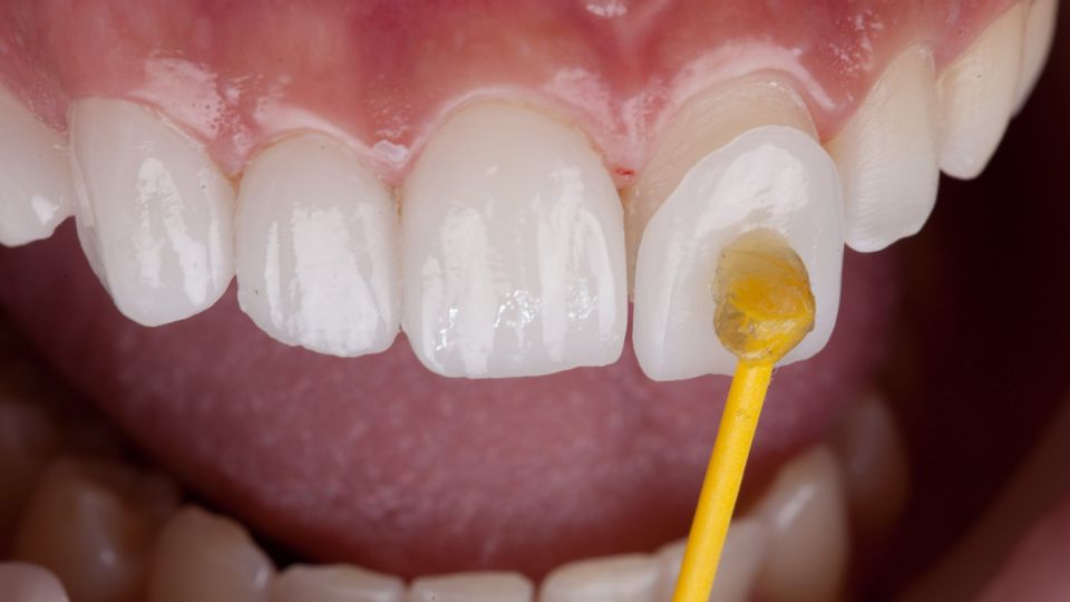 Porcelain veneers being applied to the front teeth of a patient