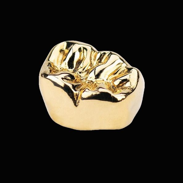 Gold Tooth Crown - Whites Dental London