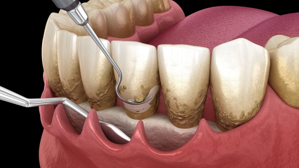 Periodontal Treatment - Scaling Root Planing