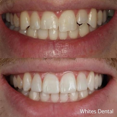 Porcelain Emax Veneers Before & After 10