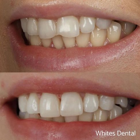 Porcelain Emax Veneers Before & After 11