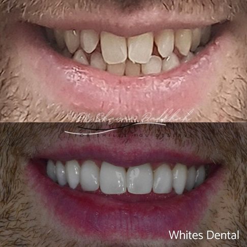 Porcelain Emax Veneers Before & After 2
