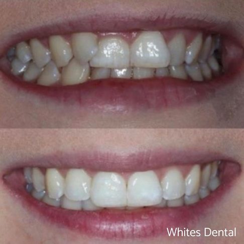 Porcelain Emax Veneers Before & After 5