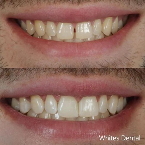 Porcelain Emax Veneers Before & After 8