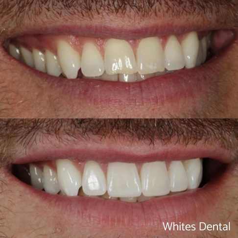 Porcelain Emax Veneers Before & After 9
