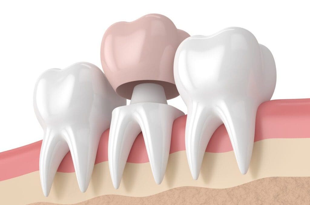 Crown Recement A Loose Crown Or A Crown That's Fallen Off