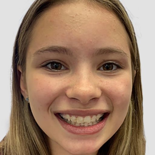 Ceramic braces for kids