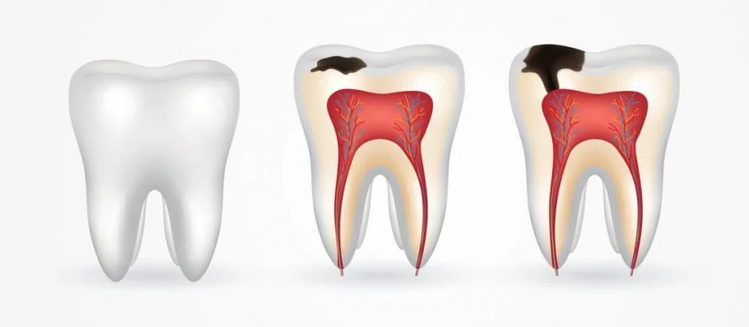 Stages Of Tooth Decay