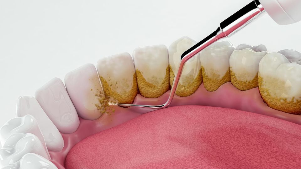 Hygienist Cleaning