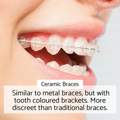 Orthodontic braces - Ceramic