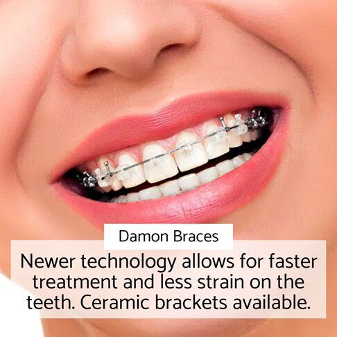 Orthodontic braces - Damon