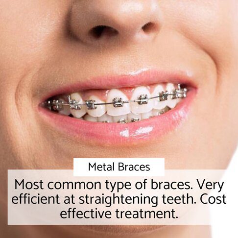 Orthodontic braces - Metal
